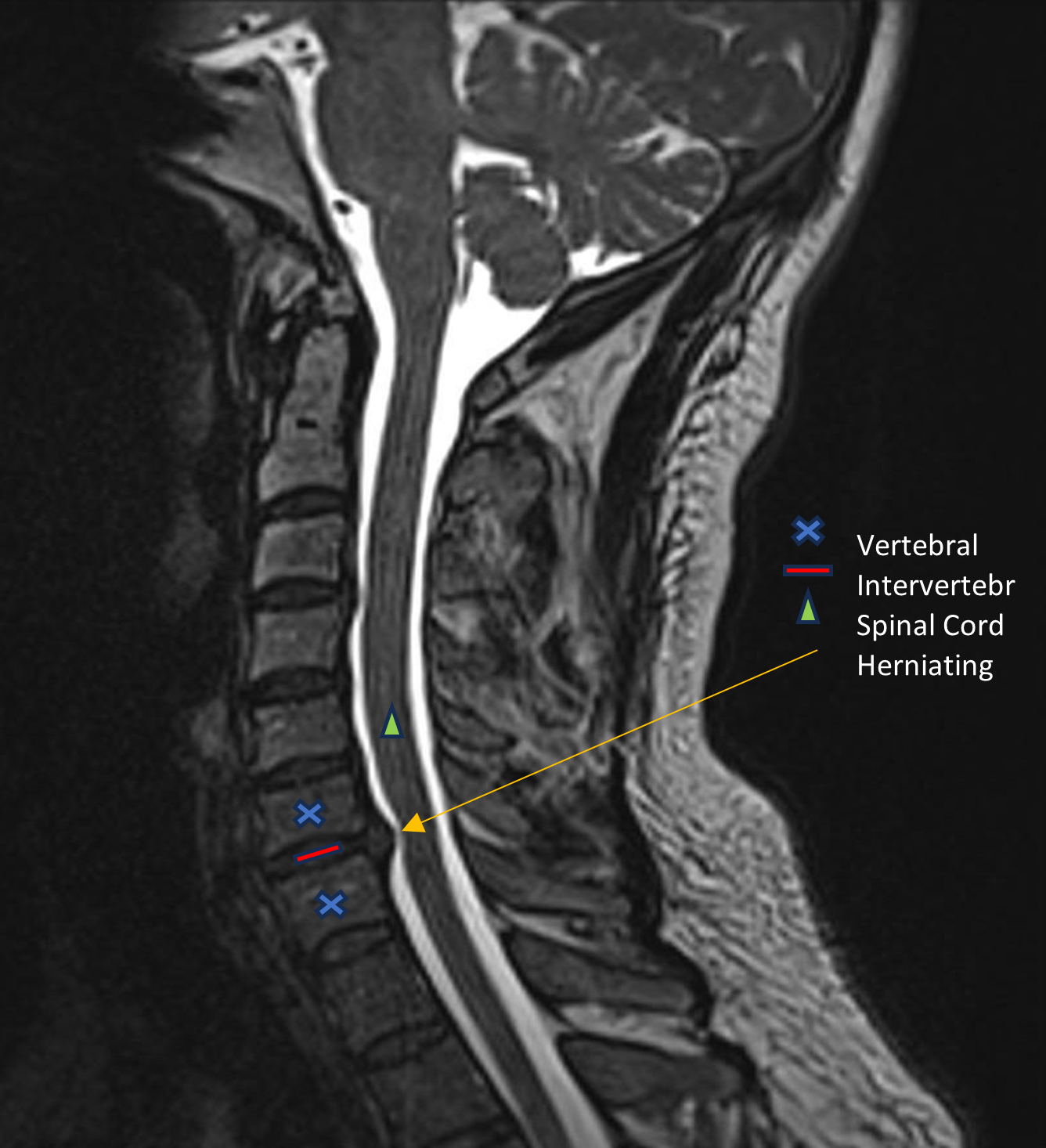MRI of bulging disks in spine