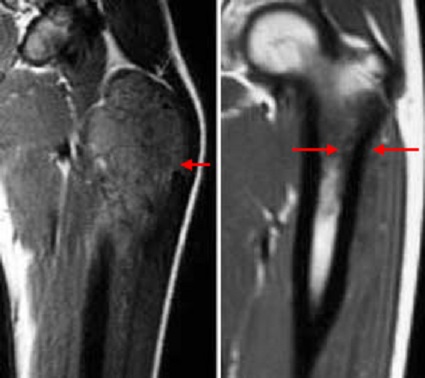 Resonancia magnética del sarcoma de Ewing antes y después de la quimioterapia