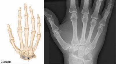 Wrist before and after proximal row carpectomy