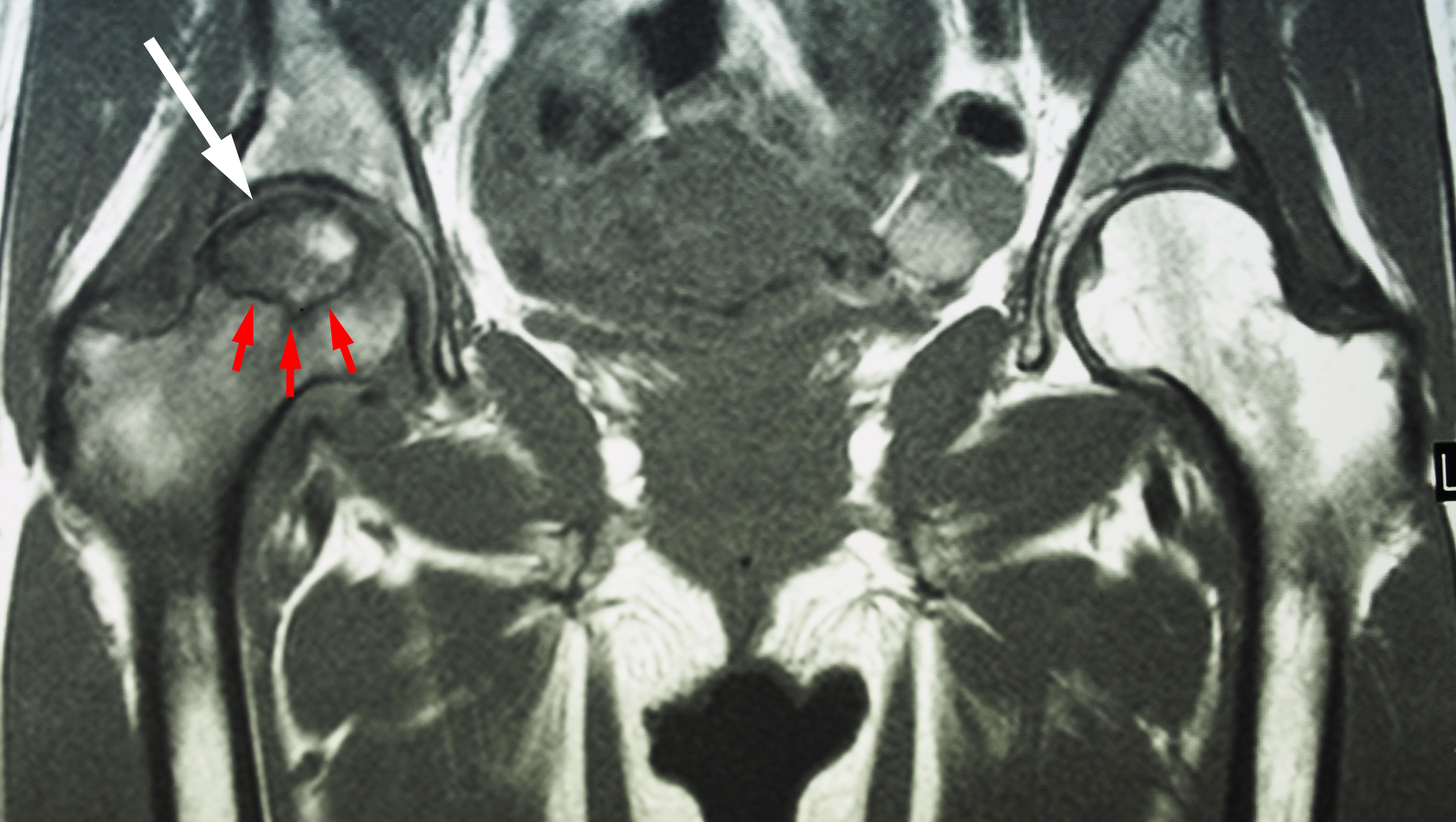 A Unenhanced Ct Scan Shows A Mass White Arrow With Necrosis White | My ...