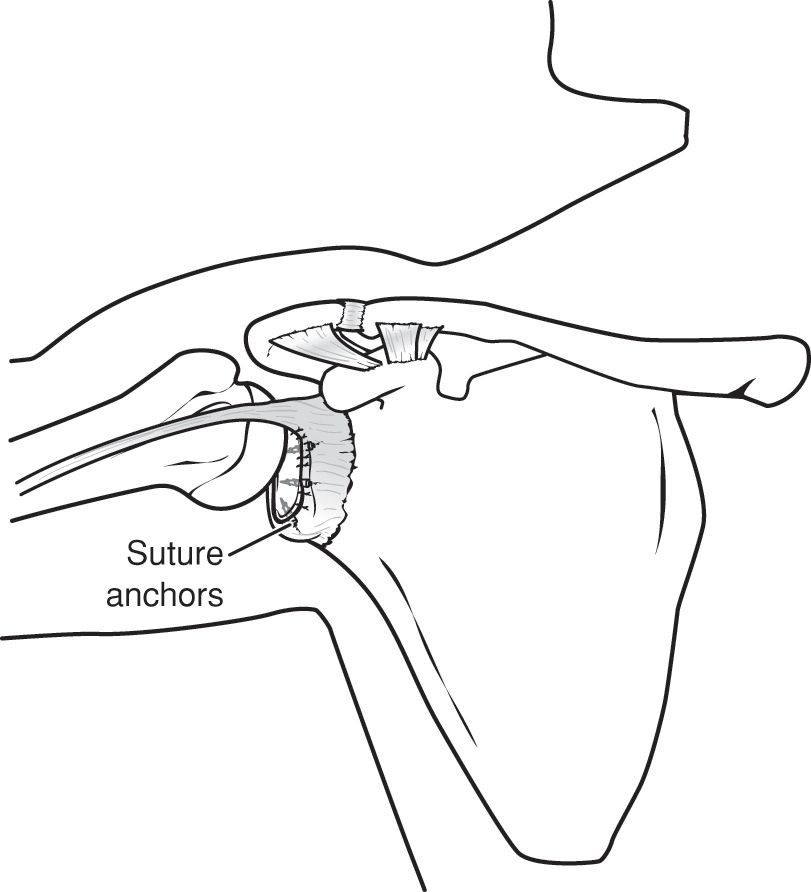 Surgical repair of a Bankart lesion