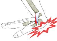 Wrist Sprains - OrthoInfo - AAOS