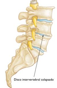 Hernia de disco en la zona lumbar