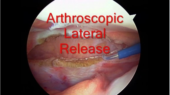 Patellofemoral Pain Syndrome - OrthoInfo - AAOS