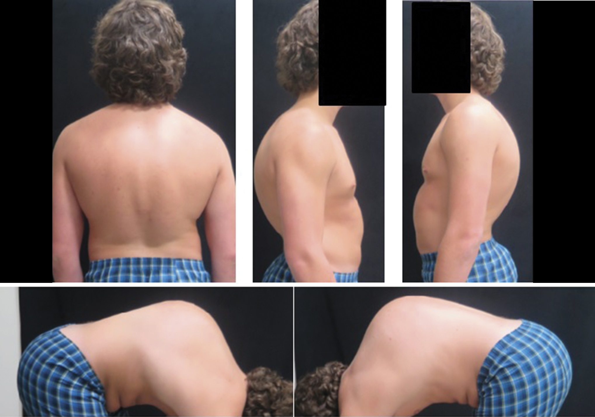 Clinical photos of an 18-year-old with kyphosis