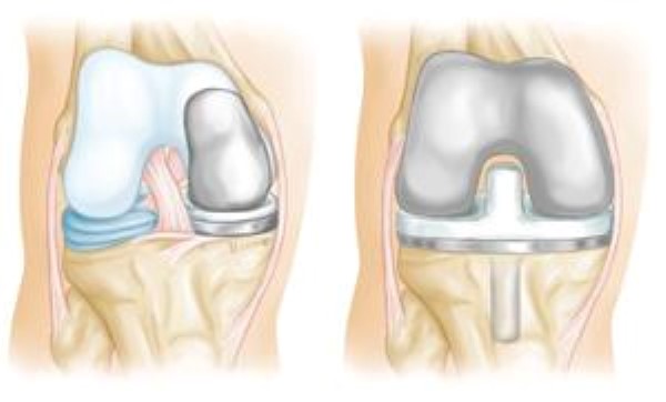 osteoarthritis knee swelling