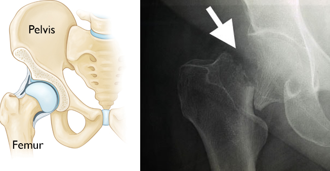 Illustration of a normal hip and x-ray of a hip fracture