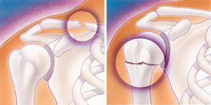Ilustraciones de fractura de clavícula y fractura de húmero proximal