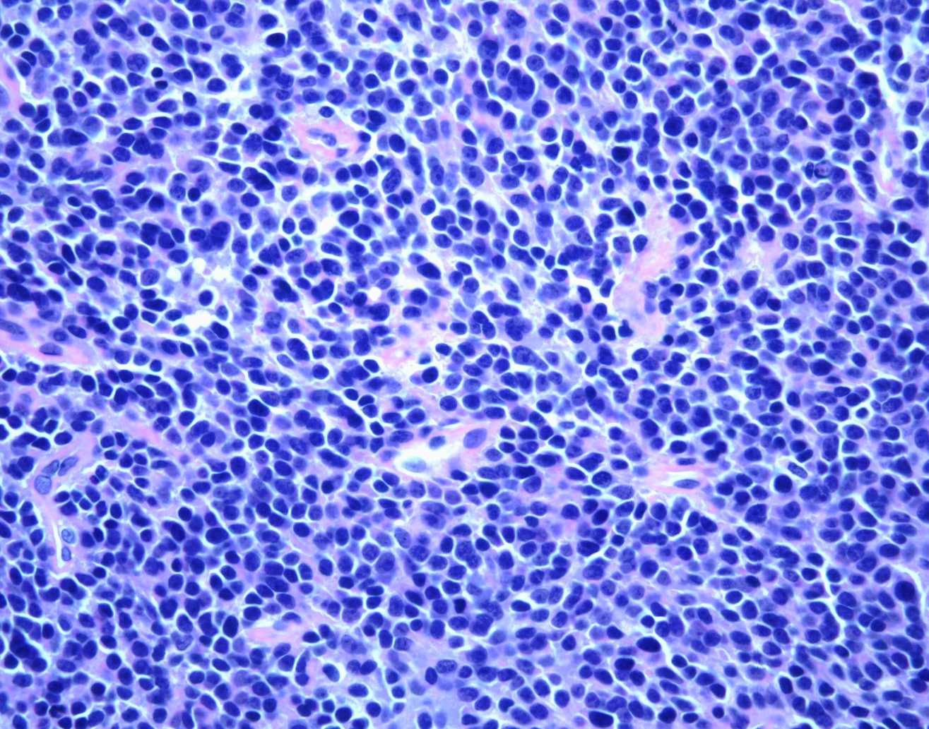 Vista microscópica del sarcoma de Ewing