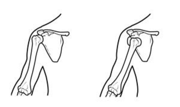 Illustration of normal shoulder stability and shoulder dislocation 