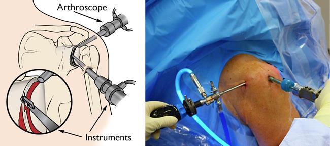 Arthroscope and surgical instruments inserted through portals in shoulder