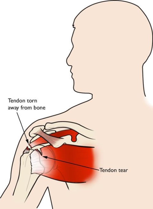 rotator cuff tear