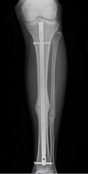 Ankle Fractures In Children - OrthoInfo - AAOS