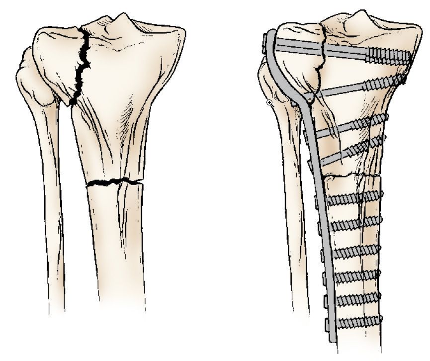 proximal tibia anatomy