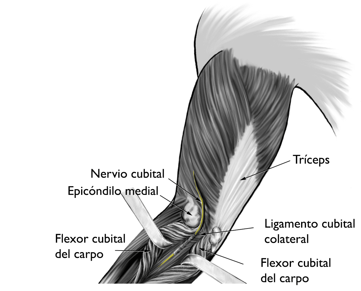 Síndrome del túnel carpiano (Carpal Tunnel Syndrome) - OrthoInfo - AAOS