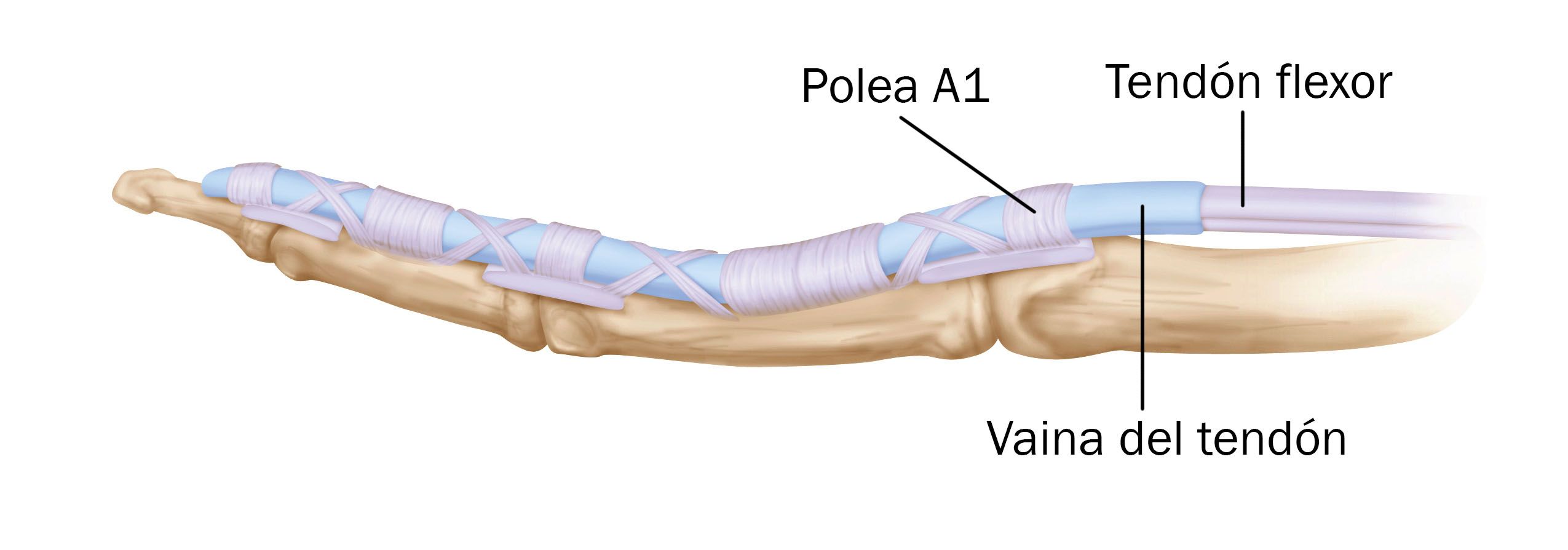 Dedo En Gatillo Trigger Finger Orthoinfo os