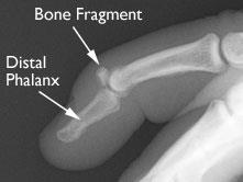 avulsion fracture finger