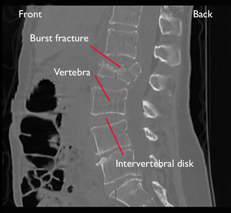 Low back fracture injuries