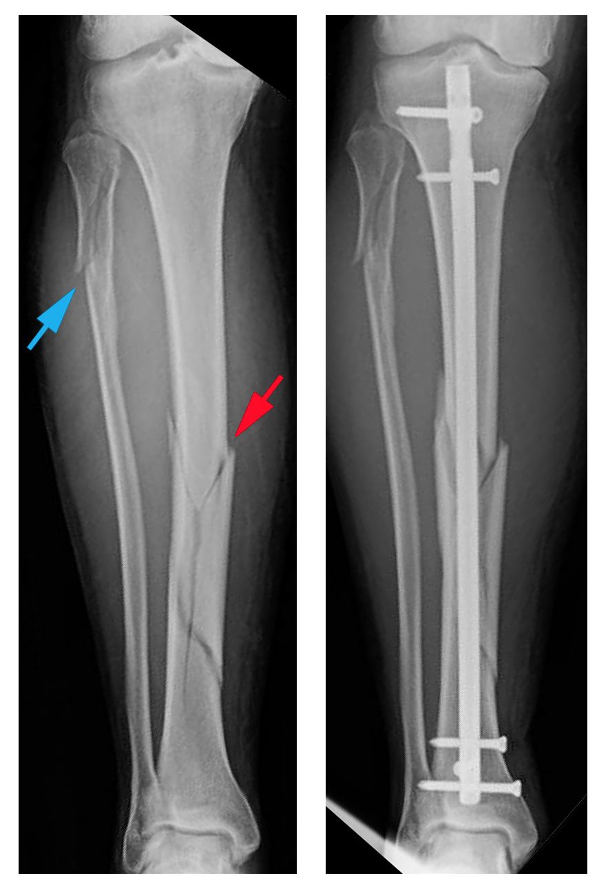 tibia and fibula x ray