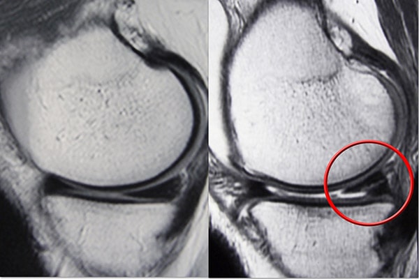 Meniscus Tears - OrthoInfo - AAOS