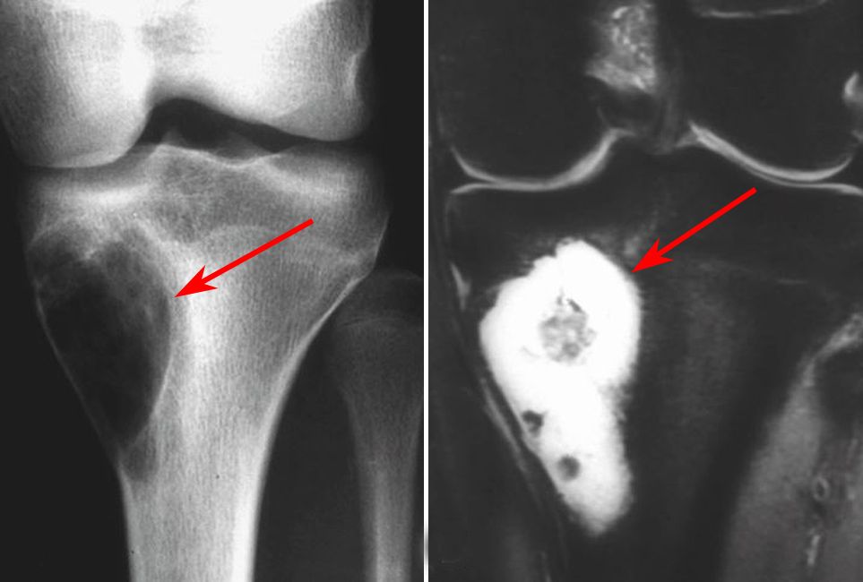 Osteosarcoma telangiectásico