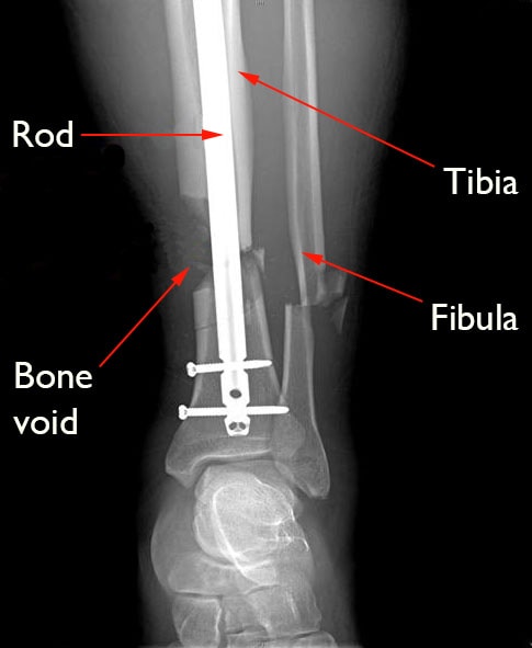 internal fixation of broken tibia