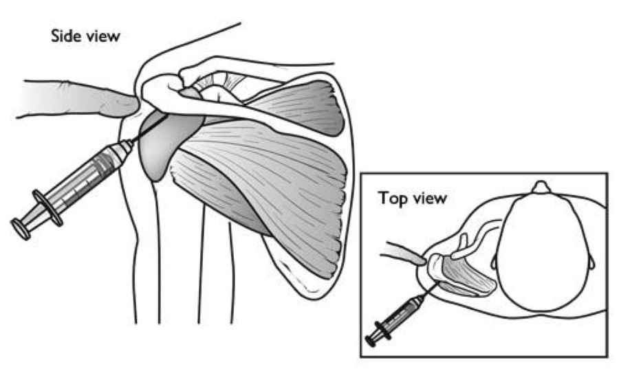 cortisone injection in shoulder