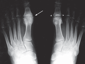 Hallux Rigidus (Stiff Big Toe) - OrthoInfo - AAOS