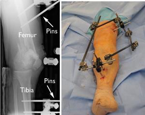 knee fracture recovery