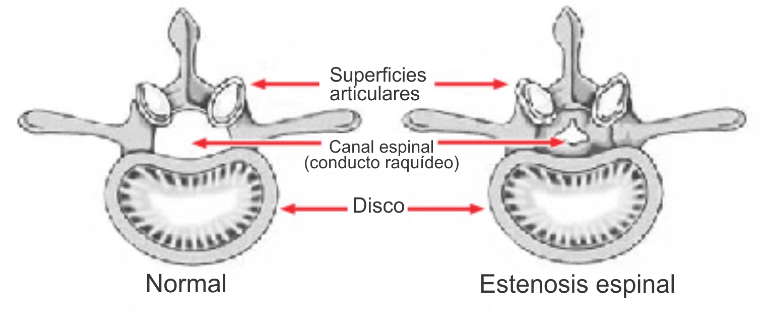 Estenosis de columna lumbar - NeuroCS