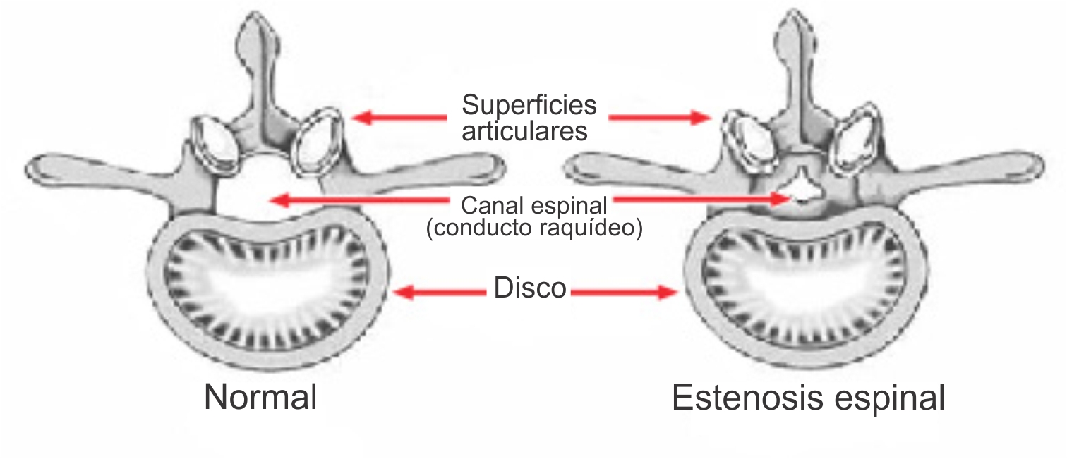 Lumbar Spinal Stenosis - OrthoInfo - AAOS