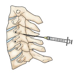 Spine Basics - OrthoInfo - AAOS