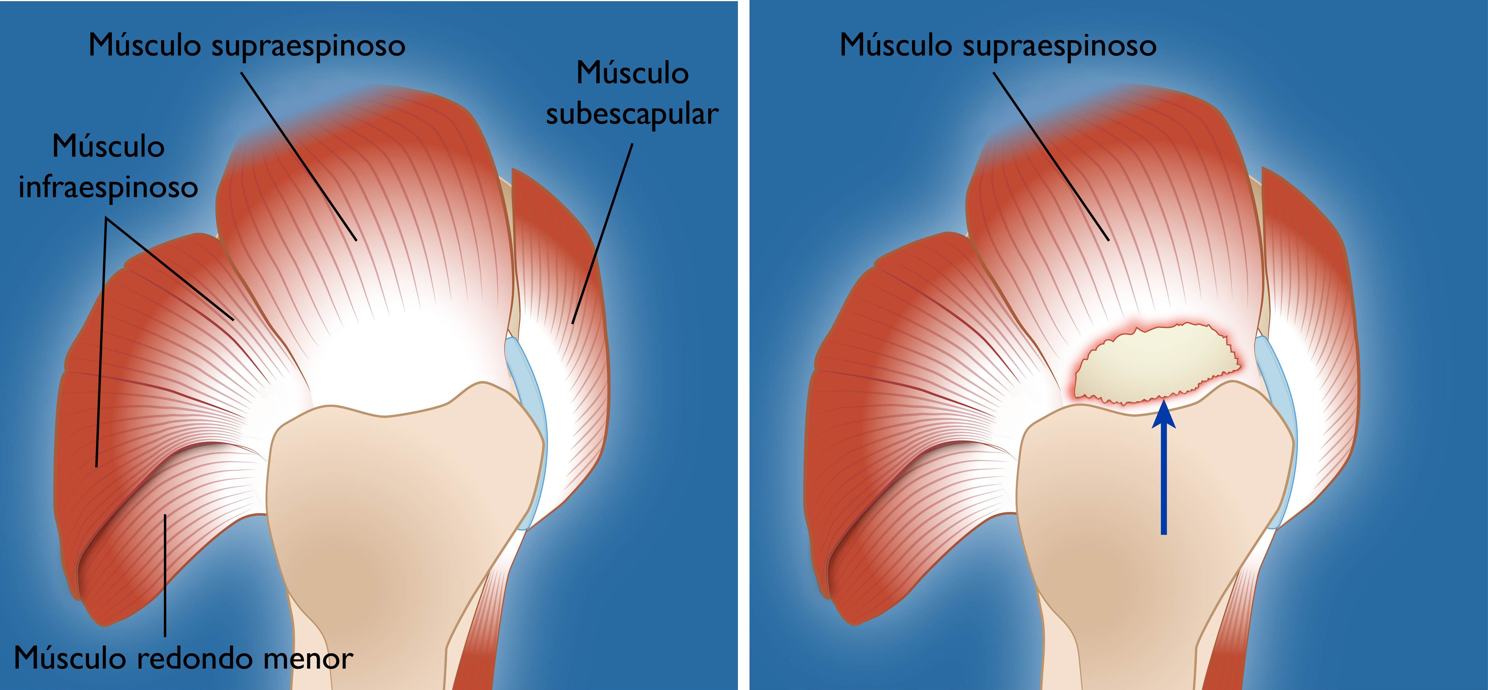 Desgarres Del Manguito De Los Rotadores Rotator Cuff Tears