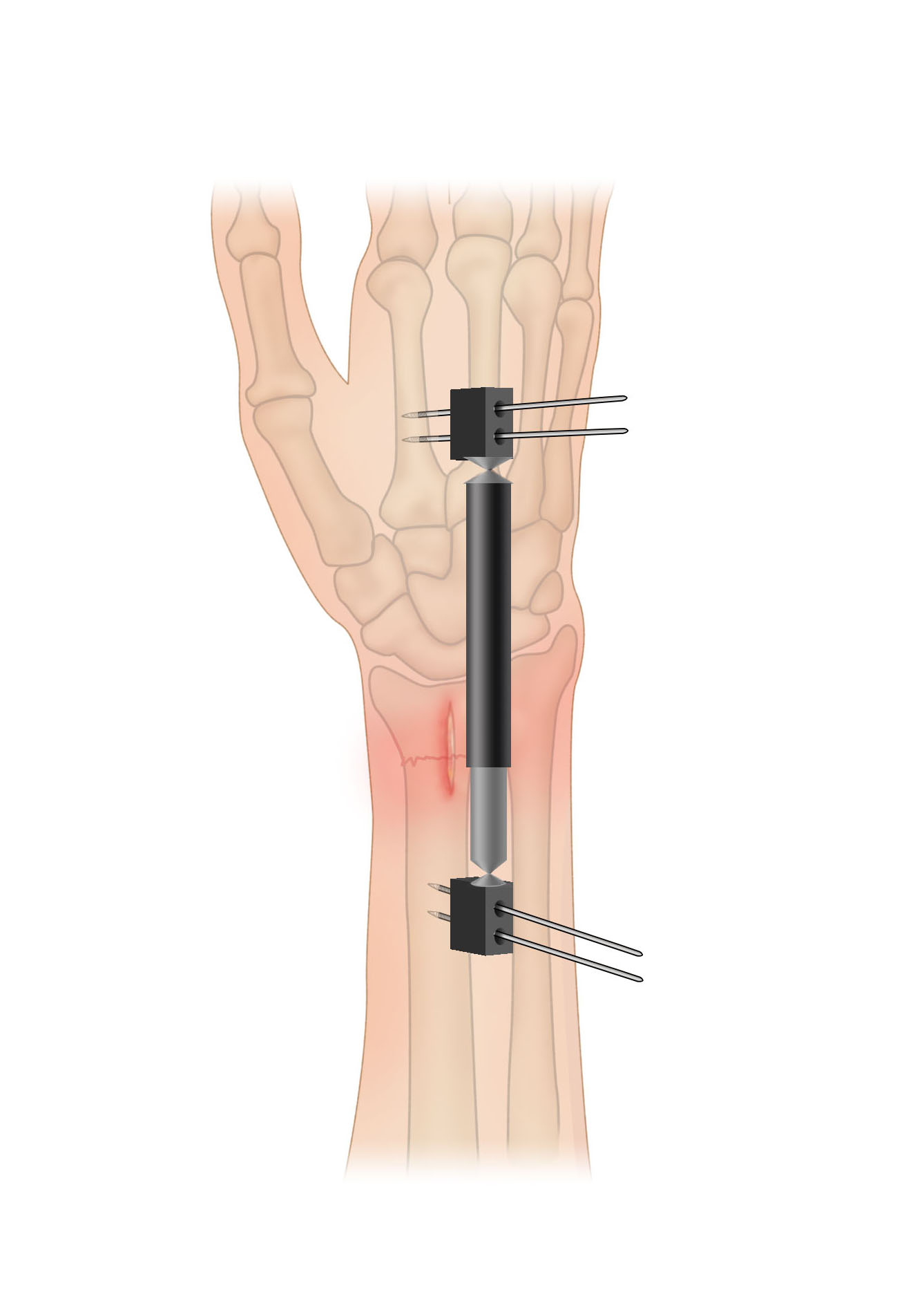 Table: Wrist Fractures: Colles and Smith - Merck Manuals Consumer Version