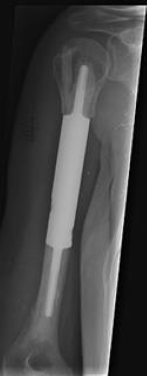 segmental spacer in humerus