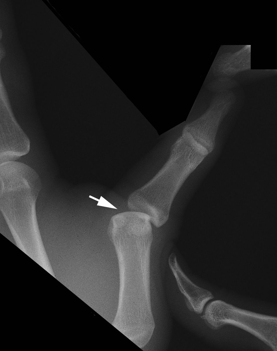 Stress x-ray of MCP joint