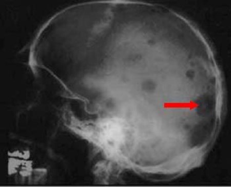 X-ray of multiple myeloma in skull