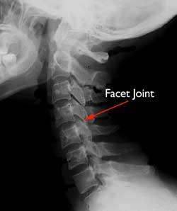 X-ray of a cervical facet joint