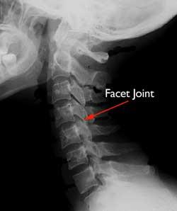 spondylosis xray