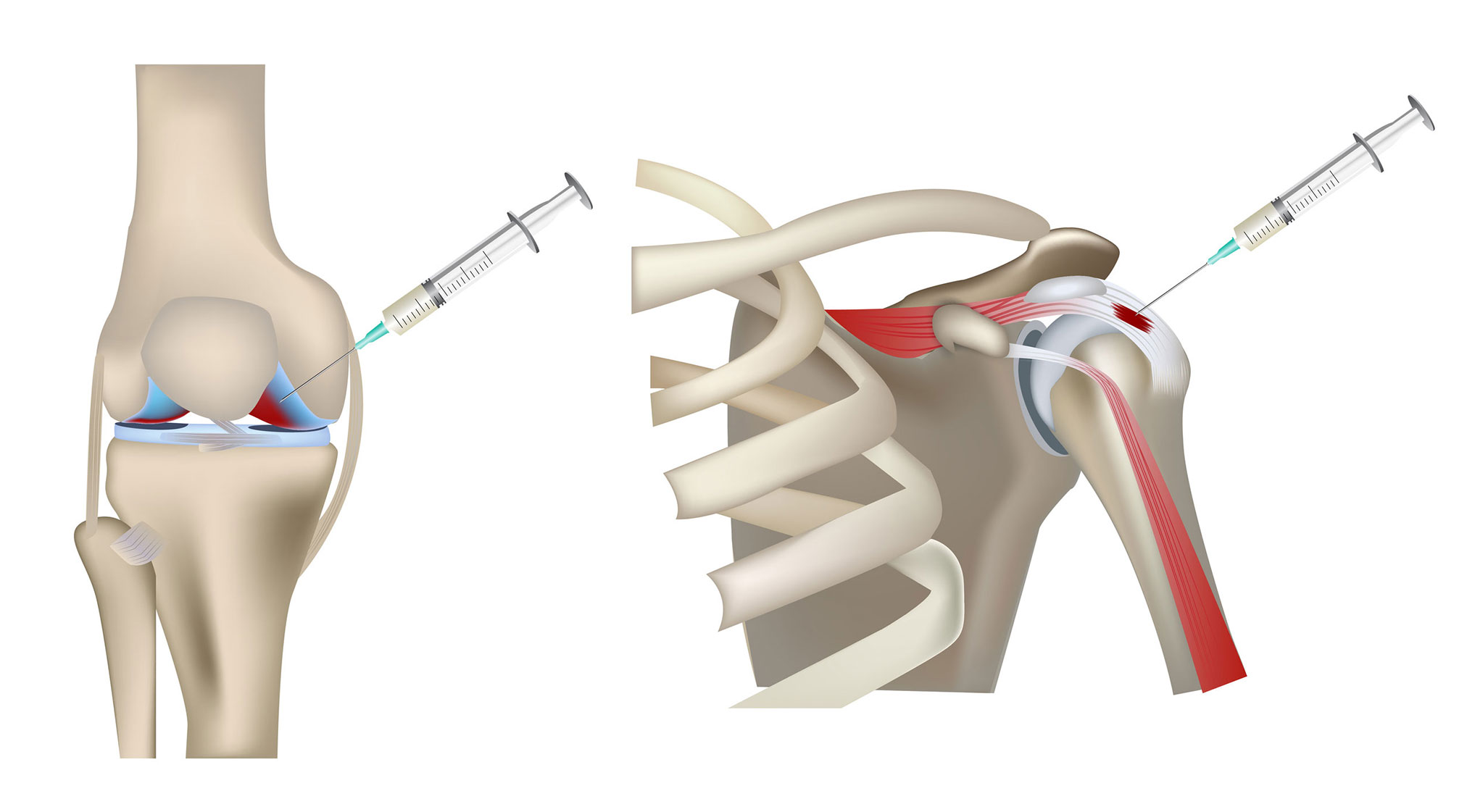 Platelet-Rich Plasma (PRP) Injections