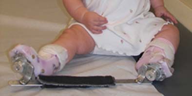 How to recognise if my baby's feet are normal or needs treatment? Clubfoot,  baby feet turning inward or outward