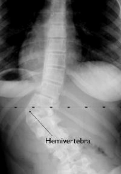 Escoliosis - Wikipedia, la enciclopedia libre