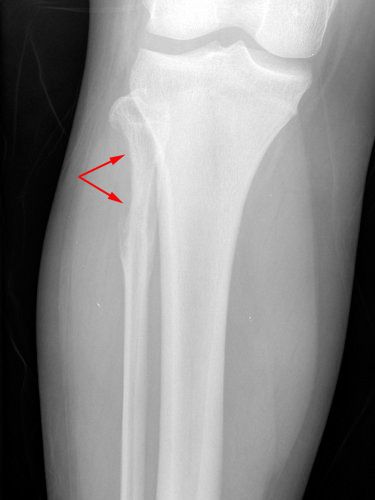 Radiografía de rodilla con sarcoma de Ewing