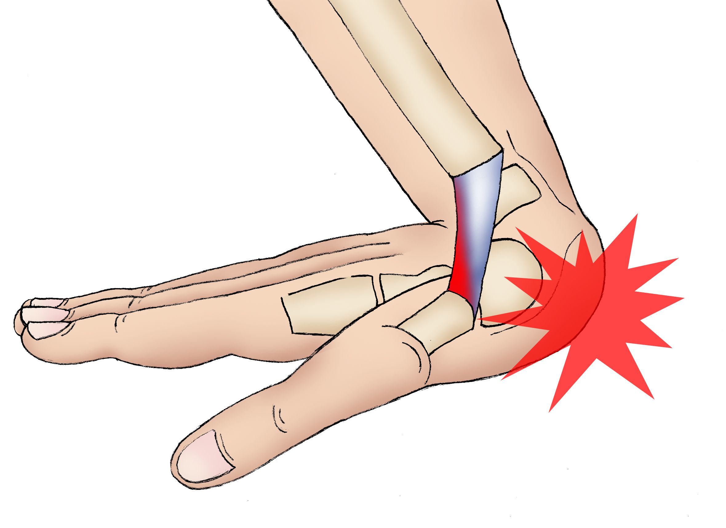 Wrist Sprains OrthoInfo AAOS