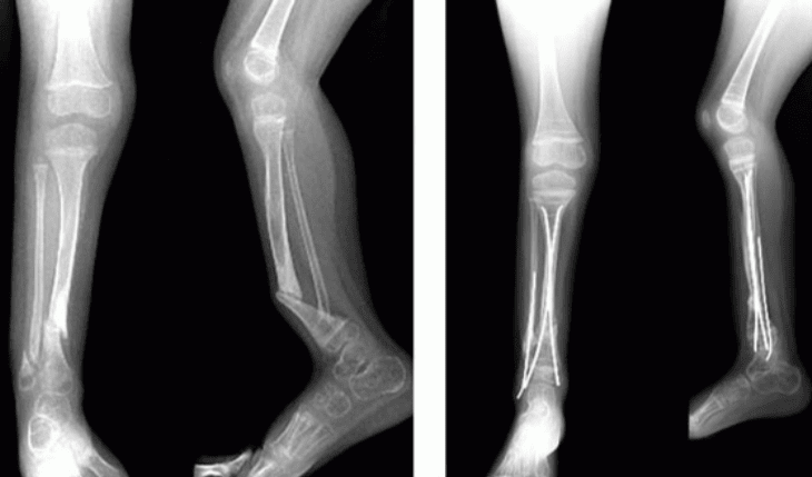 Pseudoarthrosis Before and After Surgery