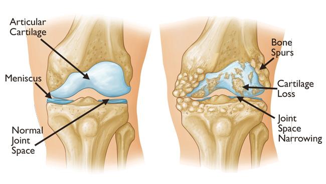 normal knee and knee with osteoarthritis and bone spurs
