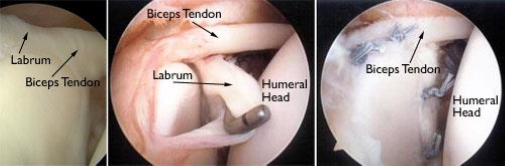 arthroscopic images of SLAP tear and repair