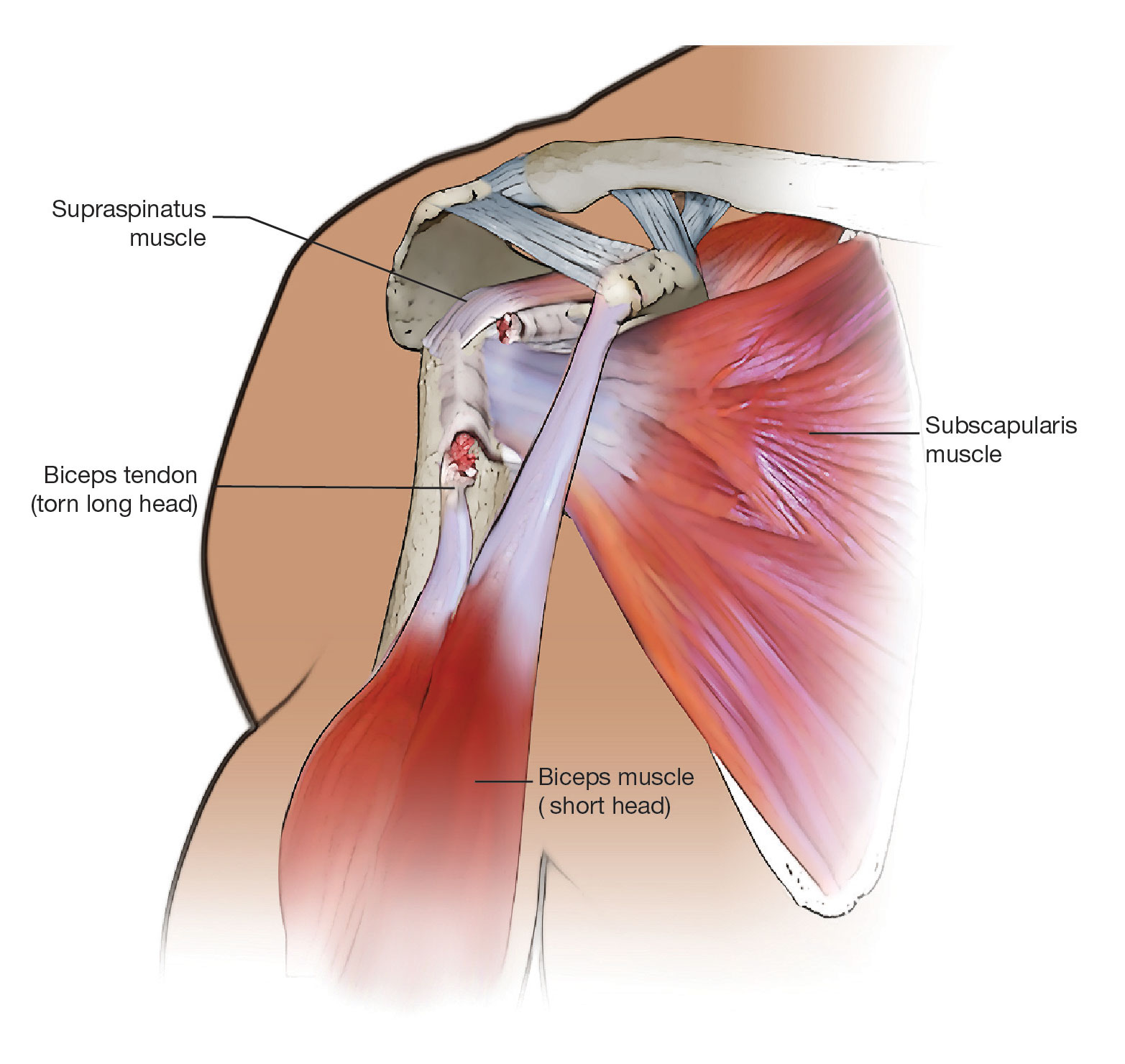 Biceps tendon tear