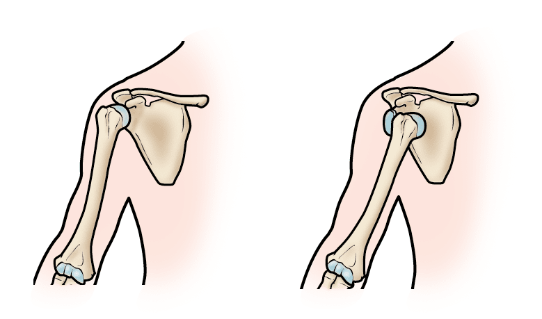 Ilustración de la estabilidad normal del hombro y la dislocación del hombro 