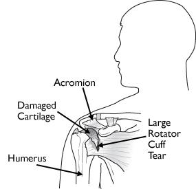 Illustration of rotator cuff arthropathy